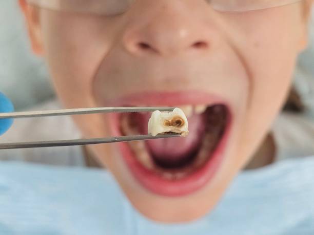 Best Emergency Dental Care for Broken or Chipped Teeth in Wintersville, OH